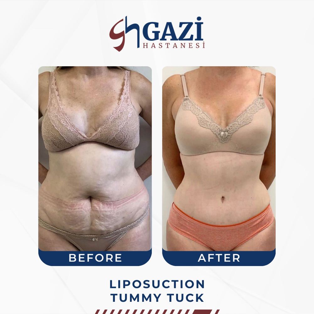 Before and After Result